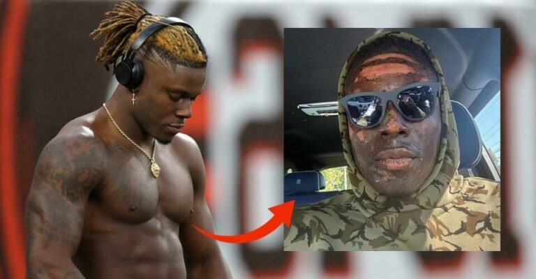 What Happened to David Njoku? How Did Njoku Burn His Face?