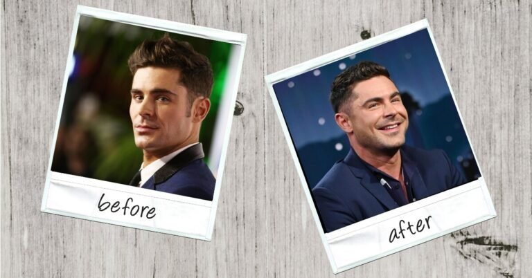 What Happened to Zac Efron's Face? Accident Explained