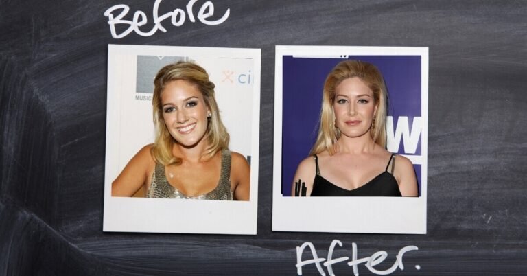 What Surgery Did Heidi Montag Have?