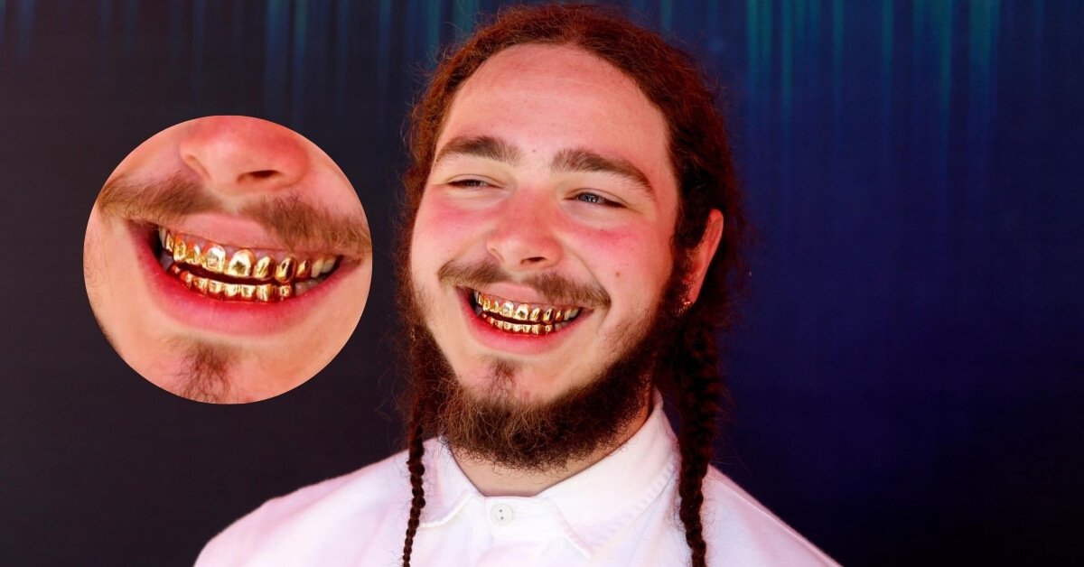 Why Does Post Malone Have Such Teeth? Are They Made Of Silver, Gold, Or