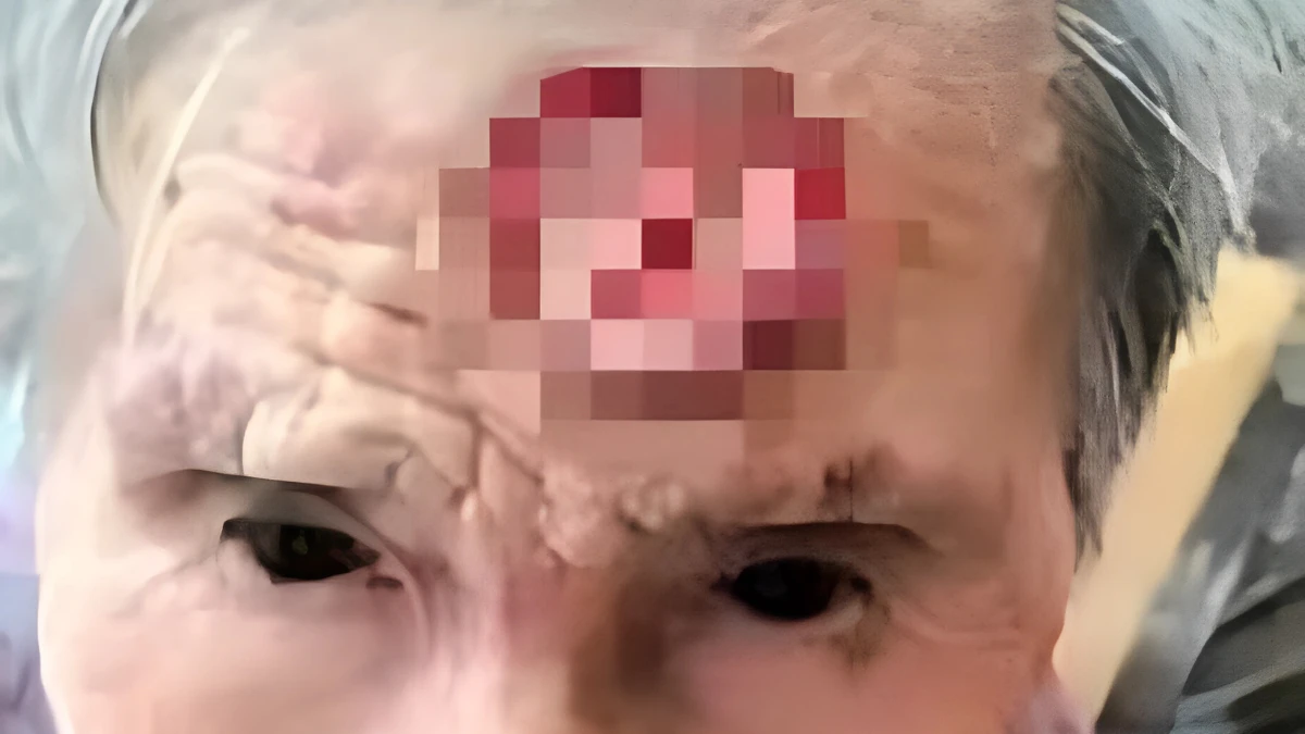 Grandma Cuts Finger-Sized Horn on Forehead with Scissors 1 Granny Gu from China cuts off her horn with scissors